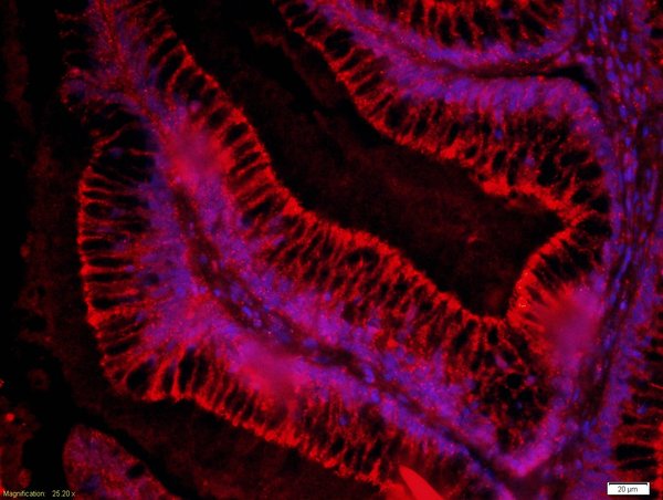 Paraformaldehyde-fixed, paraffin embedded human colon cancer; Antigen retrieval by boiling in sodium citrate buffer (pH6) for 15min; Block endogenous peroxidase by 3% hydrogen peroxide for 30 minutes; Blocking buffer (normal goat serum) at 37°C for 20min;