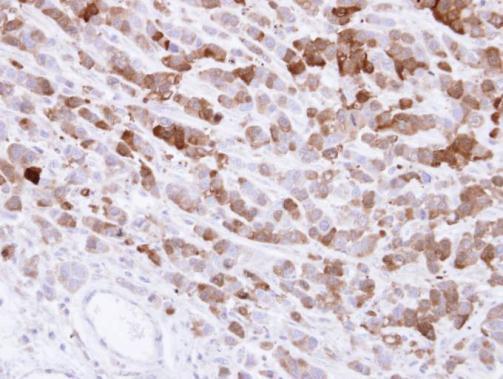 Immunohistochemical analysis of paraffin-embedded MDA-MB-468 xenograft , using AKR1C1(GRP491) antibody at 1:500 dilution.