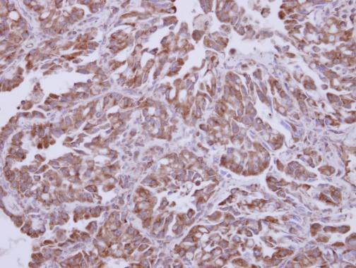 Immunohistochemical analysis of paraffin-embedded human lung adenocarcinoma, using Akt1(GRP499) antibody at 1:250 dilution.