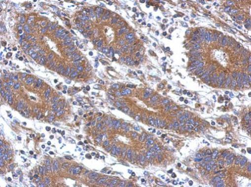 Immunohistochemical analysis of paraffin-embedded human colon carcinoma, using Angiopoietin 2(GRP469) antibody at 1:500 dilution.