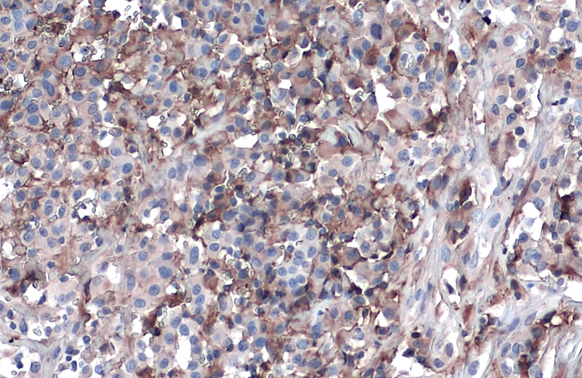Apolipoprotein A1 antibody detects secreted Apolipoprotein A1 protein by immunohistochemical analysis.Sample: Paraffin-embedded human ovarian cancer.Apolipoprotein A1 stained by Apolipoprotein A1 antibody (GRP503) diluted at 1:500.Antigen Retrieval: Citra