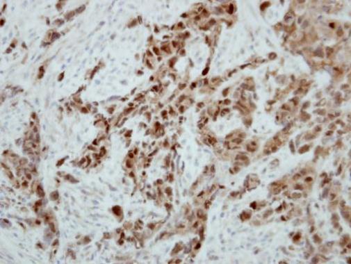 Immunohistochemical analysis of paraffin-embedded H661 xenograft, using Ataxin 3(GRP597) antibody at 1:500 dilution.