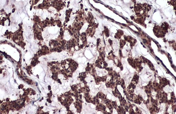 ATM antibody [2C1] detects ATM protein at nucleus by immunohistochemical analysis.Sample: Paraffin-embedded human breast carcinoma.ATM stained by ATM antibody [2C1] (GRP535) diluted at 1:100.Antigen Retrieval: Citrate buffer, pH 6.0, 15 min