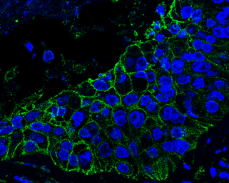 AXL antibody detects AXL protein at cell membrane in human lung cancer by immunohistochemical analysis. Sample: Paraffin-embedded human lung cancer. Green: AXL antibody (GRP526) diluted at 1:200. The signal was developed using goat anti-rabbit IgG antibod
