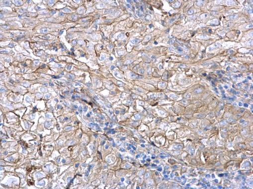 AXL antibody detects AXL protein at membrane on human non-small cell lung carcinoma by immunohistochemical analysis. Sample: Paraffin-embedded human non-small cell lung carcinoma. AXL antibody (GRP526) dilution: 1:500.