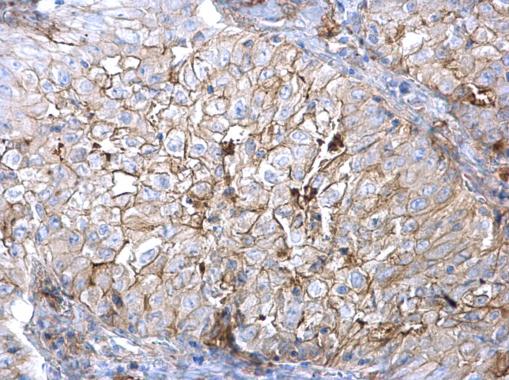 AXL antibody detects AXL protein at cell membrane on human non-small cell lung carcinoma by immunohistochemical analysis. Sample: Paraffin-embedded human non-small cell lung carcinoma. AXL antibody (GRP526) diluted at 1:500.