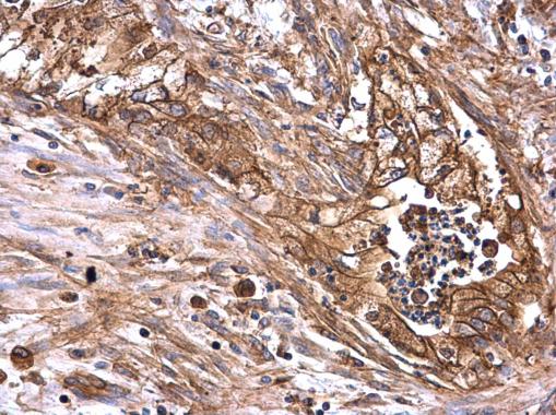 AXL antibody detects AXL protein at membrane on human colon carcinoma by immunohistochemical analysis. Sample: Paraffin-embedded human colon carcinoma. AXL antibody (GRP526) dilution: 1:500.