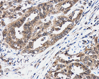Bcl-2 antibody [N1N2], N-term detects Bcl-2 protein at cytoplasm in human squamous metaplasia of cervix by immunohistochemical analysis. Sample: Paraffin-embedded human cervix. Bcl-2 antibody [N1N2], N-term (GRP455) diluted at 1:500.
