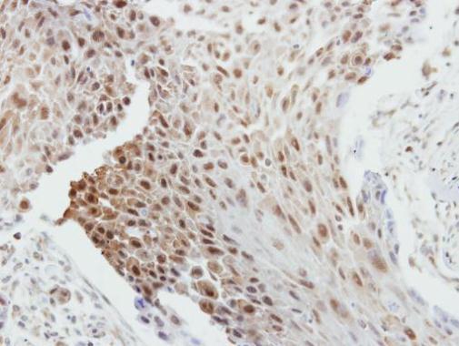 Immunohistochemical analysis of paraffin-embedded human breast cancer, using Bcl-2(GRP455) antibody at 1:250 dilution.