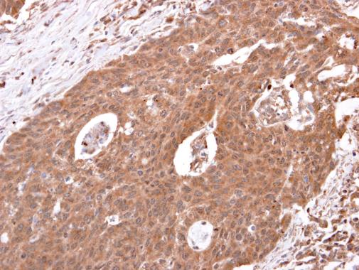beta 2 Adrenergic Receptor antibody [C2C3], C-term detects beta 2 Adrenergic Receptor protein at cytosol on human colon carcinoma by immunohistochemical analysis. Sample: beta 2 Adrenergic Receptor antibody [C2C3], C-term (GRP544) dilution: 1:250.