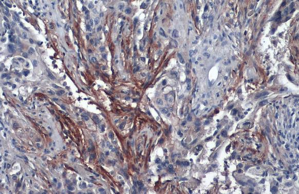 Carbonic Anhydrase IX antibody [GT12] detects Carbonic Anhydrase IX protein at cell membrane by immunohistochemical analysis.Sample: Paraffin-embedded human cervical carcinoma.Carbonic Anhydrase IX stained by Carbonic Anhydrase IX antibody [GT12] (GRP534)
