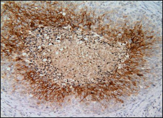 Immunohistochemical analysis of paraffin-embedded cervical CA tissue sections using anti-CAIX antibody [GT12] (GRP534) at a dilution of 1:1000. The hypoxic regions of the tumor show positive CAIX staining.