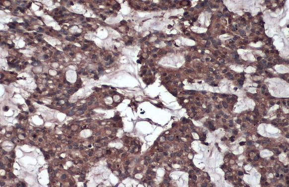 Caspase 8 antibody detects Caspase 8 protein at cytoplasm by immunohistochemical analysis.Sample: Paraffin-embedded human breast carcinoma.Caspase 8 stained by Caspase 8 antibody (GRP500) diluted at 1:1000.Antigen Retrieval: Citrate buffer, pH 6.0, 15 min