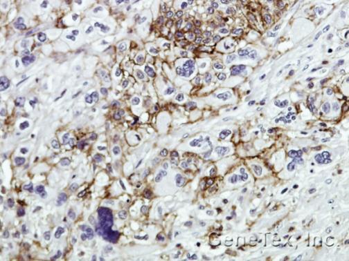 Immunohistochemical analysis of paraffin-embedded Human pancreatic tumor, using CD44(GRP477) antibody at 1:100 dilution.