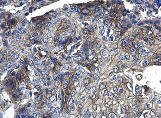 CD44 antibody detects CD44 protein at membrane and cytoplasm on human endometrial carcinoma by immunohistochemical analysis. Sample: Paraffin-embedded human endometrial carcinoma . CD44 antibody (GRP477) diluted at 1:500.