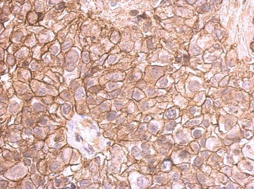 E-cadherin antibody detects E-cadherin protein at membrane on human breast cancer by immunohistochemical analysis. Sample: Paraffin-embedded breast cancer. E-cadherin antibody (GRP459) dilution: 1:500.