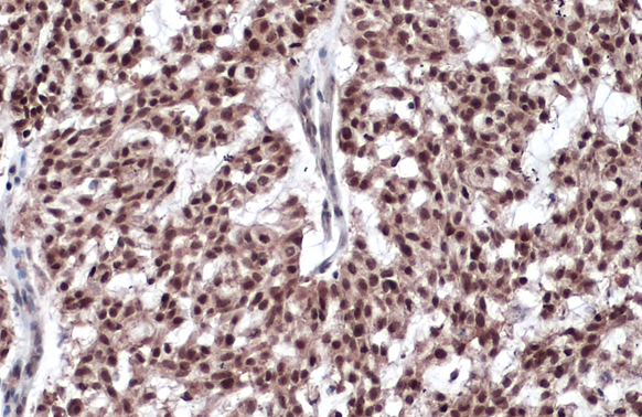 Estrogen Receptor beta antibody [14C8] detects Estrogen Receptor beta protein at nucleus by immunohistochemical analysis.Sample: Paraffin-embedded human breast carcinoma.Estrogen Receptor beta stained by Estrogen Receptor beta antibody [14C8] (GRP539) dil