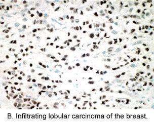 B. Infiltrating lobular carcinoma of the breast.