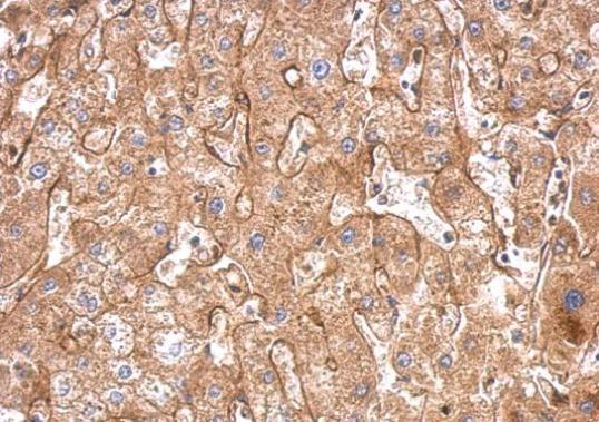 Fibronectin antibody [N1N2], N-term detects FN1 protein at cytosol on human hepatoma by immunohistochemical analysis. Sample: Paraffin-embedded hepatoma. Fibronectin antibody [N1N2], N-term (GRP505) dilution: 1:500.