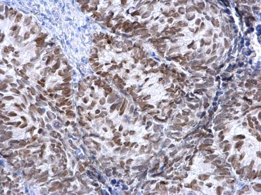 FOXA1 antibody detects FOXA1 protein at nucleus on human cervical carcinoma by immunohistochemical analysis. Sample: Paraffin-embedded human cervical carcinoma. FOXA1 antibody (GRP458) dilution: 1:500.