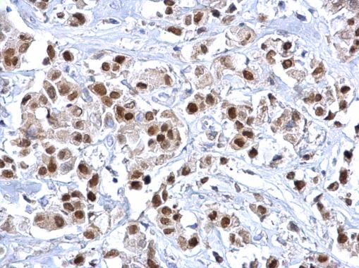 FOXA1 antibody detects FOXA1 protein at nucleus on human breast carcinoma by immunohistochemical analysis. Sample: Paraffin-embedded human breast carcinoma. FOXA1 antibody (GRP458) dilution: 1:500.