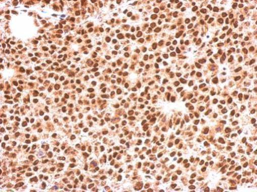Immunohistochemical analysis of paraffin-embedded Huh-7 xenograft, using FOXO3A(GRP457) antibody at 1:500 dilution.