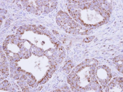 Immunohistochemical analysis of paraffin-embedded NCIN87 xenograft, using fumarate hydratase (GRP495) antibody at 1:500 dilution.