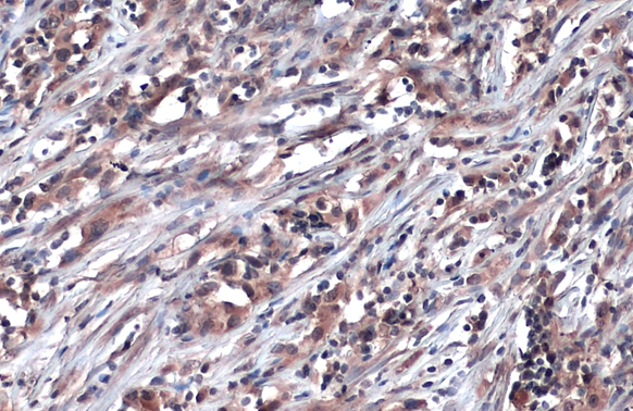 Glyoxalase I antibody [N1C3] detects Glyoxalase I protein at cytoplasm by immunohistochemical analysis.Sample: Paraffin-embedded human ovarian cancer.Glyoxalase I stained by Glyoxalase I antibody [N1C3] (GRP492) diluted at 1:500.Antigen Retrieval: Citrate