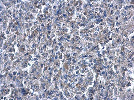 Heme Oxygenase 1 antibody detects Heme Oxygenase 1 protein at cytoplasm on human renal carcinoma by immunohistochemical analysis. Sample: Paraffin-embedded human renal carcinoma . Heme Oxygenase 1 antibody (GRP471) diluted at 1:500.
