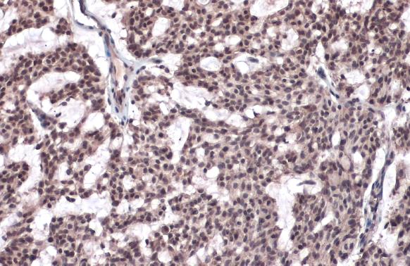 Histone H2A.XS139ph (phospho Ser139) antibody detects Histone H2A.XS139ph (phospho Ser139) protein at nucleus by immunohistochemical analysis.Sample: Paraffin-embedded human breast carcinoma.Histone H2A.XS139ph (phospho Ser139) stained by Histone H2A.XS13