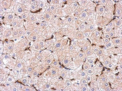 Immunohistochemical analysis of paraffin-embedded human hepatoma, using Iba1(GRP545) antibody at 1:500 dilution.