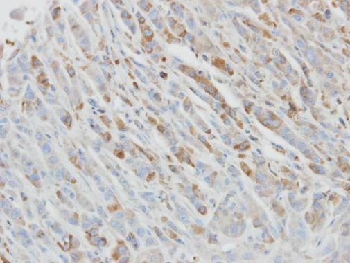 Immunohistochemical analysis of paraffin-embedded PC3 xenograft, using IL1 Receptor  antagonist(GRP571) antibody at 1:500 dilution.