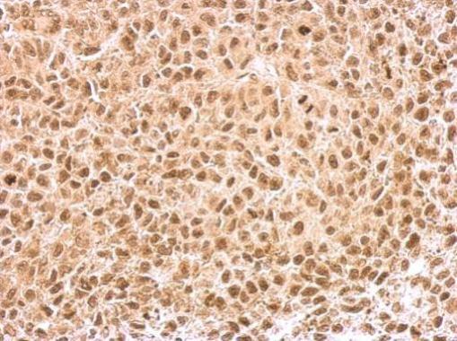 KLF5 antibody detects KLF5 protein at nucleus on HeLa xenograft by immunohistochemical analysis. Sample: Paraffin-embedded HeLa xenograft. KLF5 antibody (GRP485) dilution: 1:500.