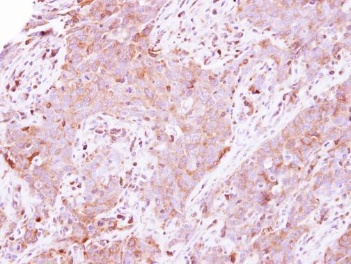 Immunohistochemical analysis of paraffin-embedded human lung papillory adenocarcinoma, using LDHA(GRP473) antibody at 1:500 dilution.
