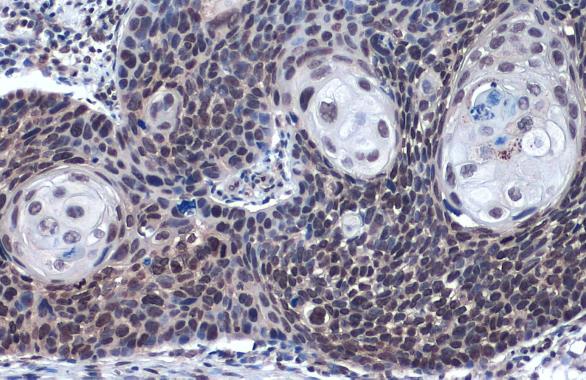 LOXL2 antibody detects LOXL2 protein at nucleus by immunohistochemical analysis.Sample: Paraffin-embedded human esophageal carcinoma.LOXL2 stained by LOXL2 antibody (GRP488) diluted at 1:3000.Antigen Retrieval: Citrate buffer, pH 6.0, 15 min