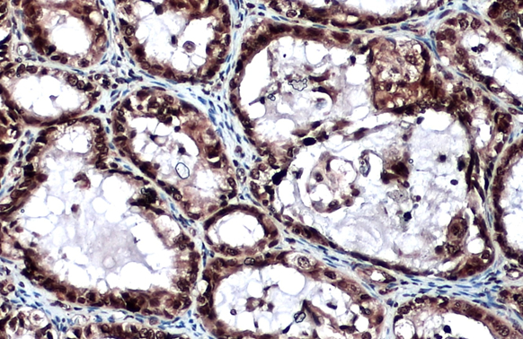 LOXL2 antibody detects LOXL2 protein at cytoplasm and nucleus by immunohistochemical analysis.Sample: Paraffin-embedded human ovarian cancer.LOXL2 stained by LOXL2 antibody (GRP488) diluted at 1:500.Antigen Retrieval: Citrate buffer, pH 6.0, 15 min