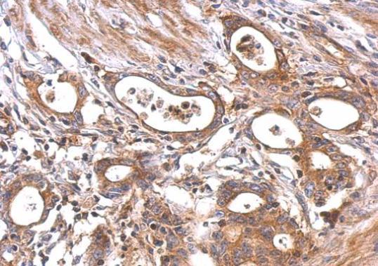 MC1 Receptor antibody [C2C3], C-term detects MC1R protein at cytosol and membrane on human colon carcinoma by immunohistochemical analysis. Sample: Paraffin-embedded colon carcinoma. MC1 Receptor antibody [C2C3], C-term (GRP575) dilution: 1:500.