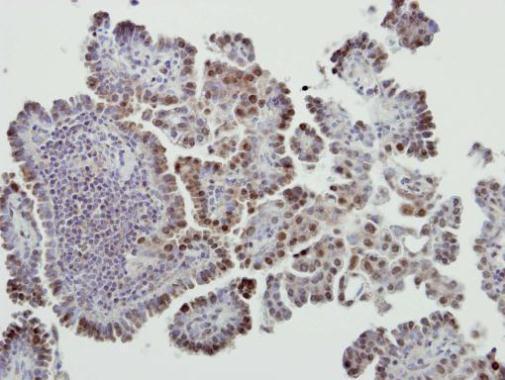 Immunohistochemical analysis of paraffin-embedded human lung cancer, using MDM2(GRP461) antibody at 1:500 dilution.
