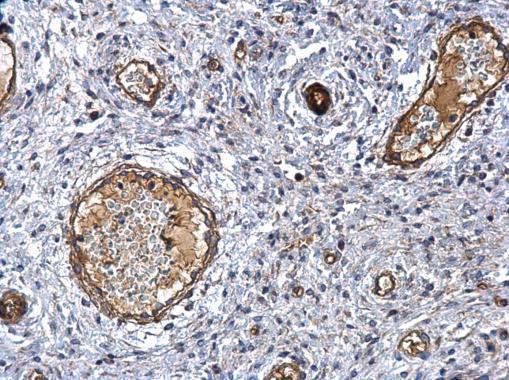 MMP1 antibody detects MMP1 protein at secreted on human cervical carcinoma by immunohistochemical analysis. Sample: Paraffin-embedded human cervical carcinoma. MMP1 antibody (GRP462) dilution: 1:500.