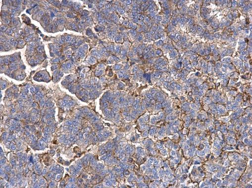 MMP1 antibody detects MMP1 protein at secreted on human endometrial carcinoma by immunohistochemical analysis. Sample: Paraffin-embedded human endometrial carcinoma. MMP1 antibody (GRP462) dilution: 1:500.