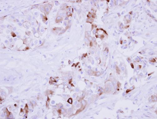 Immunohistochemical analysis of paraffin-embedded human breast cancer, using MMP1(GRP462) antibody at 1:250 dilution.