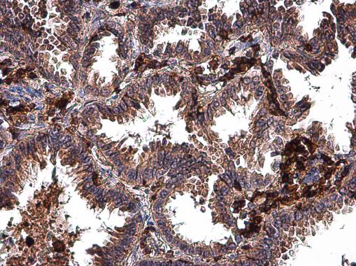 MMP2 antibody detects MMP2 protein at extracellular matrix in human lung cancer by immunohistochemical analysis. Sample: Paraffin-embedded human lung cancer. MMP2 antibody (GRP486) diluted at 1:500.