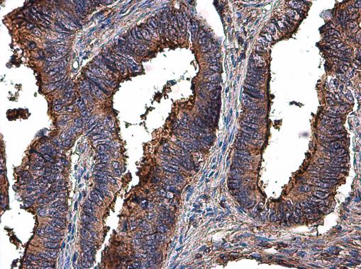 MMP2 antibody detects MMP2 protein at extracellular matrix in human colon cancer by immunohistochemical analysis. Sample: Paraffin-embedded human colon cancer. MMP2 antibody (GRP486) diluted at 1:500.