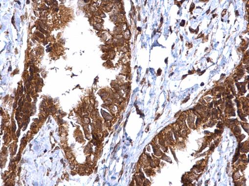 MMP2 antibody detects MMP2 protein at cytosol and nucleus on human ovarian carcinoma by immunohistochemical analysis. Sample: Paraffin-embedded human ovarian carcinoma. MMP2 antibody (GRP486) dilution: 1:500.