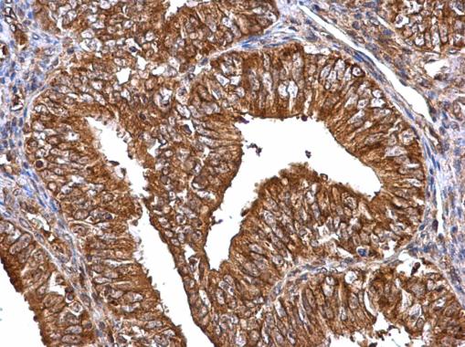 MMP2 antibody detects MMP2 protein at cytosol on human endometrial carcinoma by immunohistochemical analysis. Sample: Paraffin-embedded human endometrial carcinoma. MMP2 antibody (GRP486) dilution: 1:500.