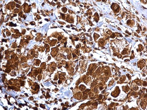MMP2 antibody detects MMP2 protein at cytosol and nucleus on human breast carcinoma by immunohistochemical analysis. Sample: Paraffin-embedded human breast carcinoma. MMP2 antibody (GRP486) dilution: 1:500.