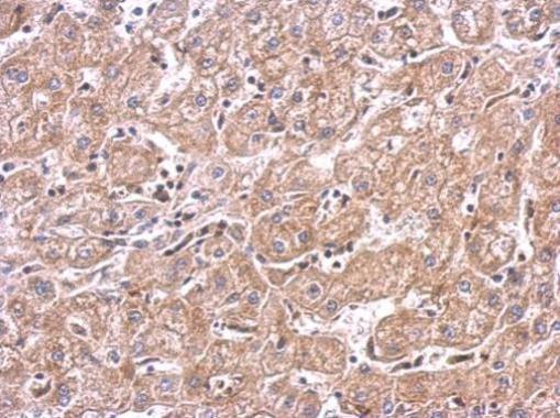 mTOR antibody detects FRAP1 protein at cytosol on human hepatoma by immunohistochemical analysis. Sample: Paraffin-embedded hepatoma. mTOR antibody (GRP476) dilution: 1:500.