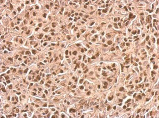 p21 Cip1 antibody detects CDKN1A protein at nucleus on SkHep1xenograft by immunohistochemical analysis. Sample: Paraffin-embedded SkHep1xenograft. p21 Cip1 antibody (GRP507) dilution: 1:500.