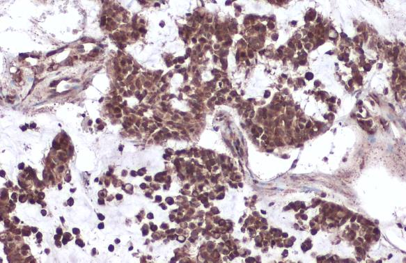 p53 antibody detects p53 protein at cytoplasm and nucleus by immunohistochemical analysis.Sample: Paraffin-embedded human breast carcinoma.p53 stained by p53 antibody (GRP482) diluted at 1:500.Antigen Retrieval: Citrate buffer, pH 6.0, 15 min