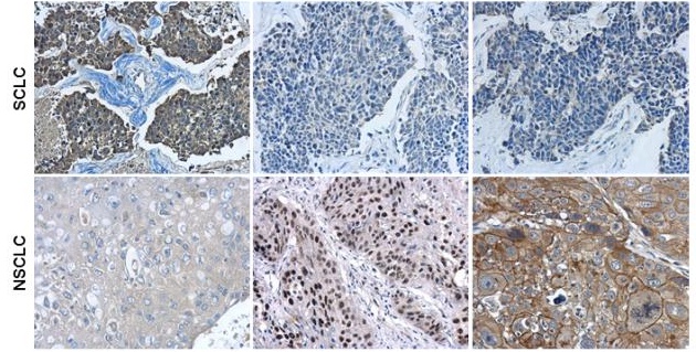 Immunohistochemical characterization of Synaptophysin (GRP478), p63 (GRP478) and Cytokeratin 7 in human small cell lung cancer (SCLC) and non-small cell lung cancer (NSCLC) specimens.Sample: Paraffin-embedded human SCLC (upper panel) and NSCLC (lower pane